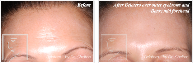 <?php echo $pk; ?> - Before and after