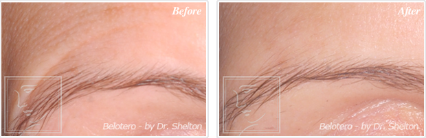 <?php echo $pk; ?> - Before and after