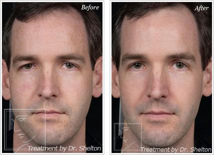 <?php echo $pk; ?> - Before and After