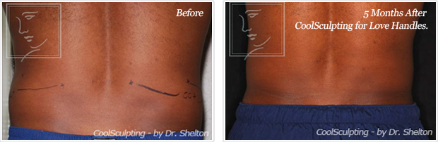 <?php echo $pk; ?> - Before and After