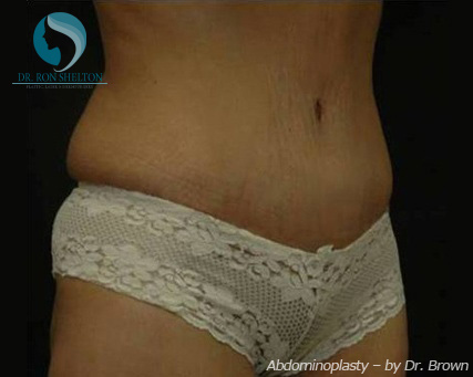 <?php echo $pk; ?> - After Case 11