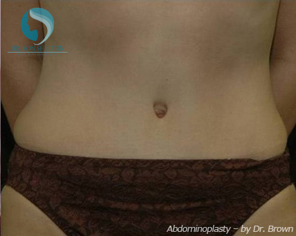 <?php echo $pk; ?> - After Case 7