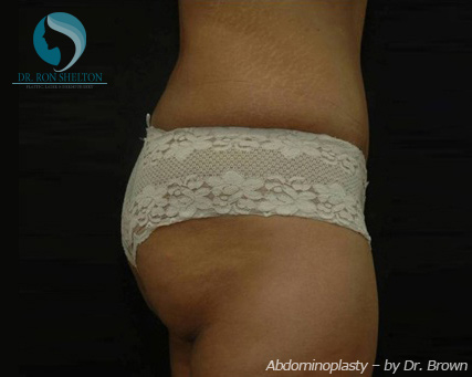 <?php echo $pk; ?> - After Case 12