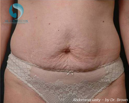 <?php echo $pk; ?> - Before Case 1