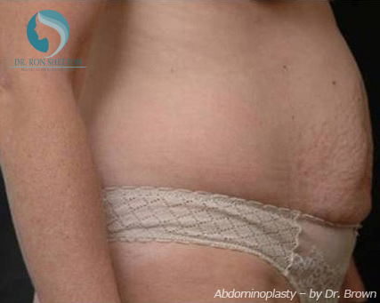 <?php echo $pk; ?> - Before Case 3