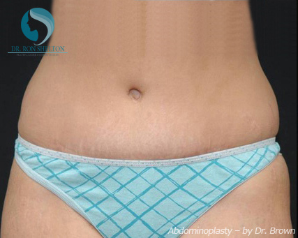 <?php echo $pk; ?> - After Case 13