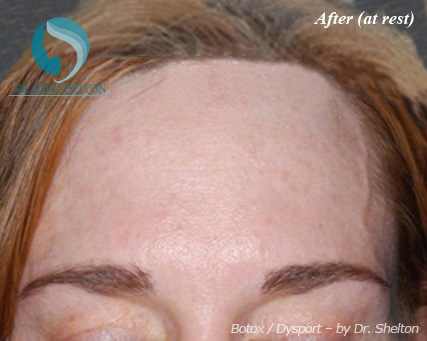 <?php echo $pk; ?> - After Case 1