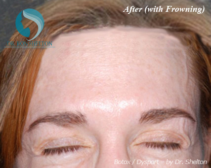 <?php echo $pk; ?> - After Case 2