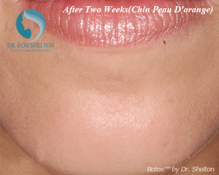 <?php echo $pk; ?> - After Case 4