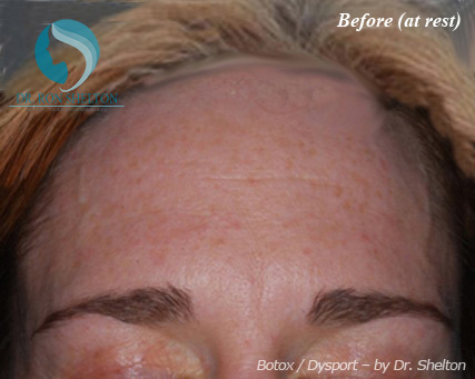 <?php echo $pk; ?> - Before Case 1