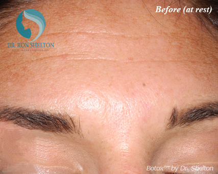 <?php echo $pk; ?> - Before Case 3