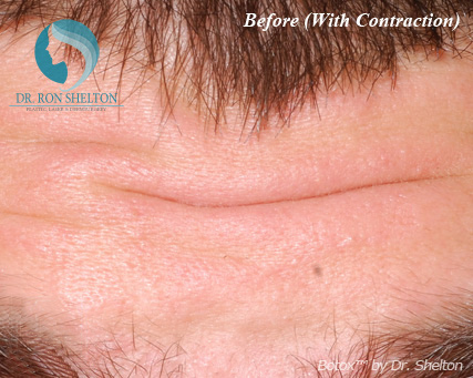 <?php echo $pk; ?> - Before Case 5