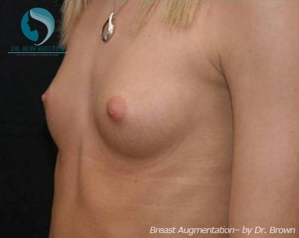 <?php echo $pk; ?> - After Case 3