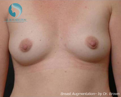 <?php echo $pk; ?> - Before Case 1