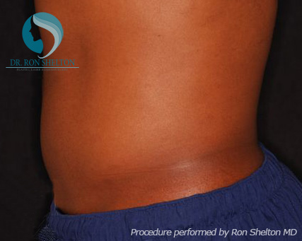 <?php echo $pk; ?> - After Case 2