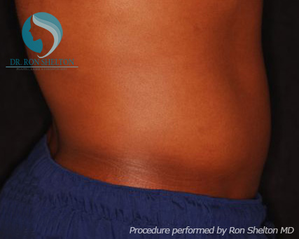 <?php echo $pk; ?> - After Case 3