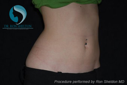 <?php echo $pk; ?> - After Case 4