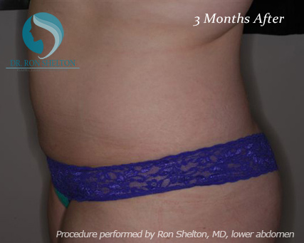 <?php echo $pk; ?> - After Case 8