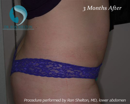 <?php echo $pk; ?> - After Case 9