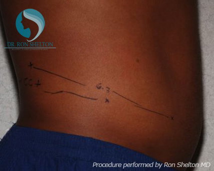 <?php echo $pk; ?> - Before Case 3