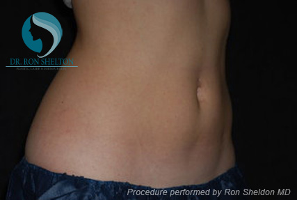 <?php echo $pk; ?> - Before Case 4