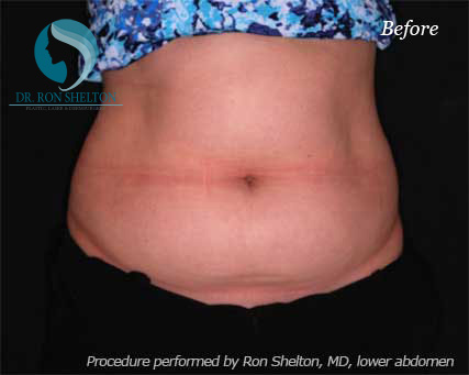 <?php echo $pk; ?> - Before Case 7