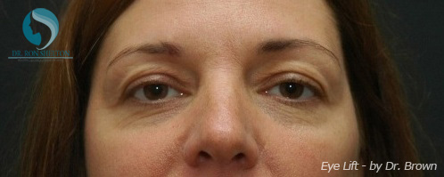 <?php echo $pk; ?> - Before Case 1