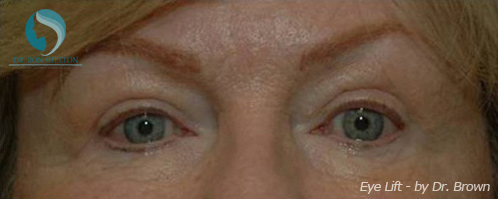 <?php echo $pk; ?> - After Case 6