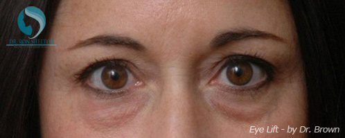 <?php echo $pk; ?> - Before Case 3