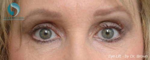 <?php echo $pk; ?> - After Case 4