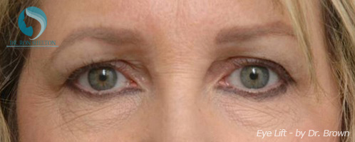 <?php echo $pk; ?> - Before Case 4