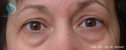 <?php echo $pk; ?> - Before Case 2