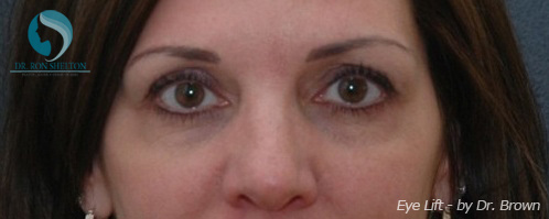 <?php echo $pk; ?> - After Case 1