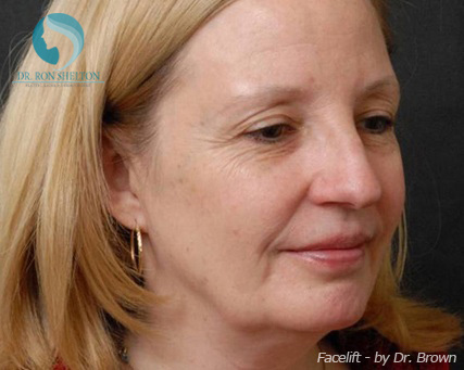 <?php echo $pk; ?> - Before Case 12