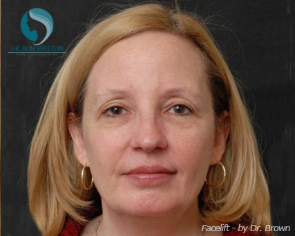 <?php echo $pk; ?> - Before Case 13