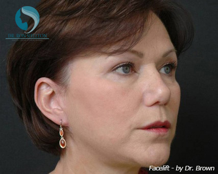 <?php echo $pk; ?> - After Case 2