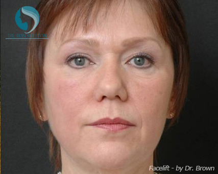 <?php echo $pk; ?> - Before Case 1