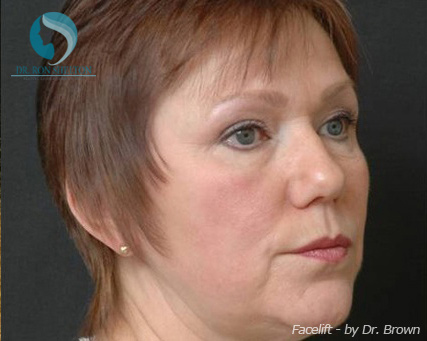 <?php echo $pk; ?> - Before Case 2