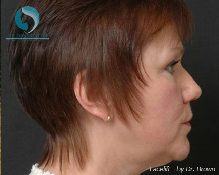 <?php echo $pk; ?> - Before Case 3