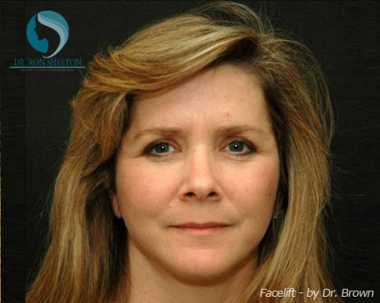 <?php echo $pk; ?> - After Case 7