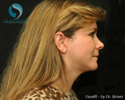 <?php echo $pk; ?> - After Case 8