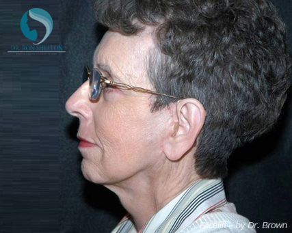 <?php echo $pk; ?> - After Case 17