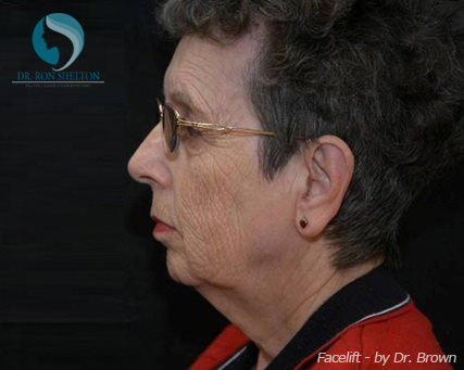 <?php echo $pk; ?> - Before Case 17