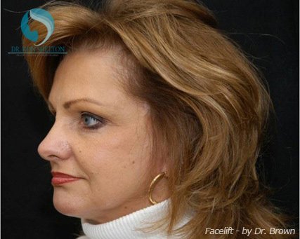 <?php echo $pk; ?> - After Case 5