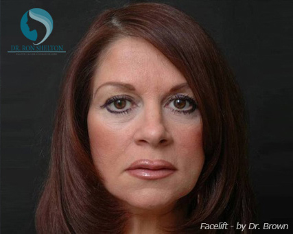 <?php echo $pk; ?> - After Case 9