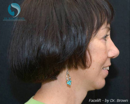 <?php echo $pk; ?> - After Case 14