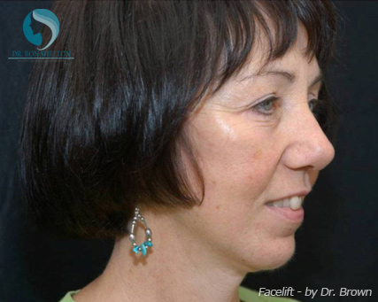 <?php echo $pk; ?> - After Case 15