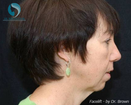 <?php echo $pk; ?> - Before Case 14