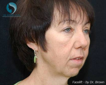 <?php echo $pk; ?> - Before Case 15