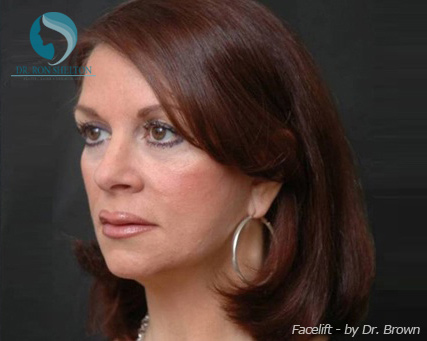 <?php echo $pk; ?> - After Case 10